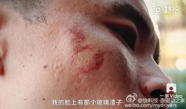 男子手部和臉部不同程度被炸傷。